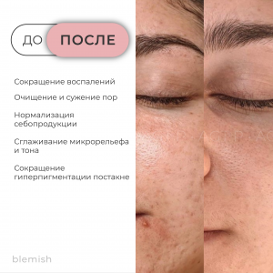 рич-контент-блемиш_blemish-4